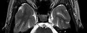 Choroid Plexus Papilloma CT Scan