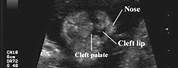 Cleft Lip and Palate Ultrasound