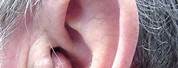 Cyst In-Ear Canal