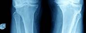 Knee Arthritis X-ray