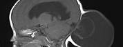 Occipital Encephalocele Brain MRI