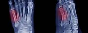 What Is a Jones Fracture