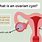12 Cm Cyst On Ovary