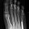 5th Metatarsal Base Fracture