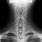 AP Cervical Spine X-ray