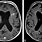 Abnormal Brain CT Scan