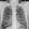 Abnormal Lung CT Scan