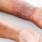 Acute Atopic Dermatitis