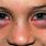 Allergic Reaction Eye Swelling
