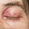 Allergy Eye Infection