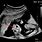 Anencephaly in Ultrasound