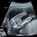 Baby Boy Gender Ultrasound