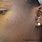 Black Spots On African American Skin