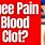 Blood Clot On Knee Cap