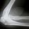 Bone Spur On Elbow