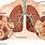 COPD and Emphysema