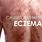 Causes of Eczema in Adults
