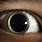 Choristoma Eye
