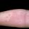 Common Skin Rashes On Arms