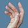 Contact Dermatitis Hands Treatment