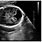 Dandy-Walker Fetal Ultrasound