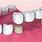 Dental Bridge Types