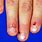 Dermatomyositis Nails