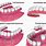 Different Dentures Types
