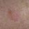 Dry Patch Skin Cancer