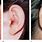Ear Canal Lesions