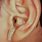 Ear Diphtheria In-Ear