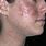 Eczema Herpeticum Face