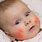 Eczema On Babies