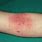 Eczema Rash On Elbows