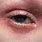 Eczema in Eyes