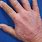 Eczema in Hands