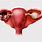 Endometriosis Ovarian Cyst
