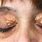 Eye Growths On Eyelid