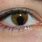 Eye Iris Problems