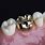 Gold Crown On Tooth