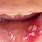 HPV Virus On Tongue
