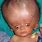 Hydrocephalus Baby Pictures