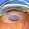 Intraocular Lens Replacement
