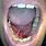 Lesion Under Tongue