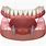 Lower Denture Implants