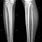 Lower Leg X-ray