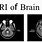 MRI of Brain Stem
