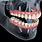 Maxillary Dental Implant