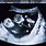 Monozygotic Twins Ultrasound