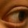 Morgellons Disease Eyes